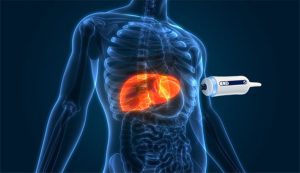 فیبرو اسکن دوره‌ای برای بیماران دیابتی: چرا این تست حیاتی است؟