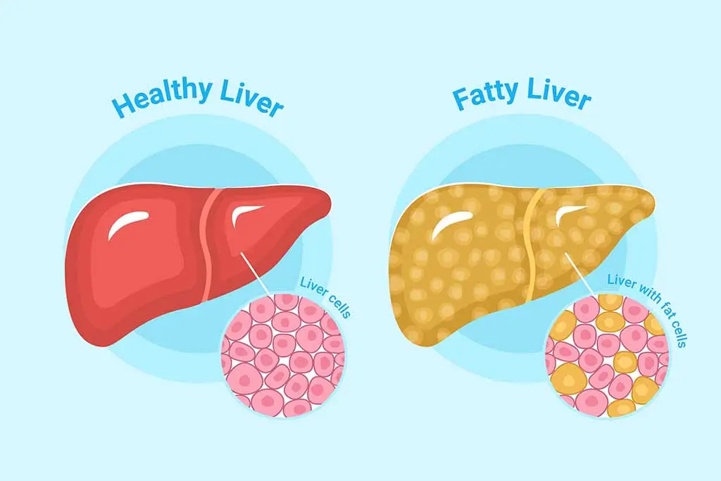 کبد چرب: دلایل ایجاد، علائم و راهکارهای درمان و پیشگیری